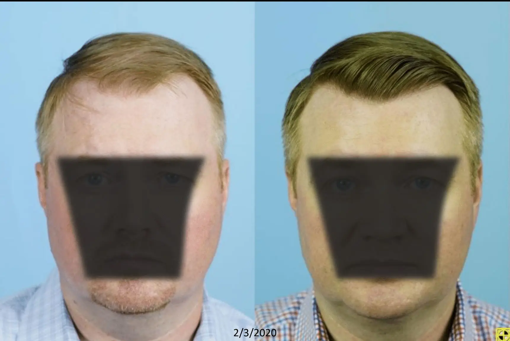 Before and after image showcasing a hair restoration treatment on a male patient. The left side displays the patient's hairline prior to the procedure, while the right side highlights the results post-treatment. Both images are set against a light blue background, emphasizing the changes in hair density and style. This visual representation aims to illustrate the effectiveness of the treatment in improving hair appearance and boosting confidence.