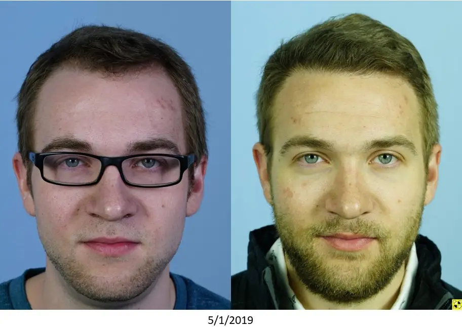 Two side-by-side headshots of a man taken on 5/1/2019. The left image features him with glasses and a blue shirt, while the right image shows him without glasses, sporting a beard and a black jacket. Both images have a light blue background, highlighting the changes in his appearance over time. The comparison illustrates facial transformations, including hairstyle and facial hair. This image serves as a visual reference for discussing personal growth or changes in style.