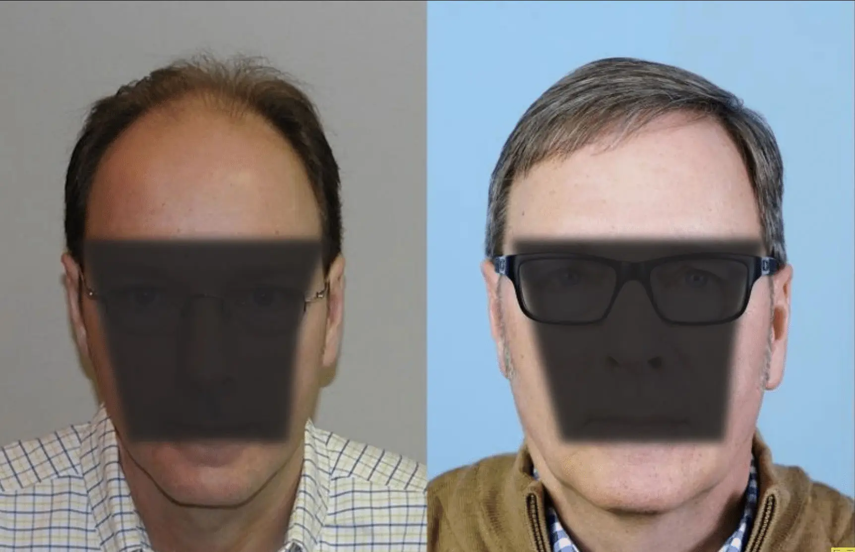 Image shows two side-by-side portraits of a man with different hairstyles and glasses. The left image features a man with thinning hair and no glasses, while the right image shows the same man with a fuller hairstyle and wearing glasses. The backgrounds are light gray and blue, respectively. This comparison highlights changes in appearance, possibly related to age or style. The images aim to illustrate the effects of grooming and personal style choices on overall look.