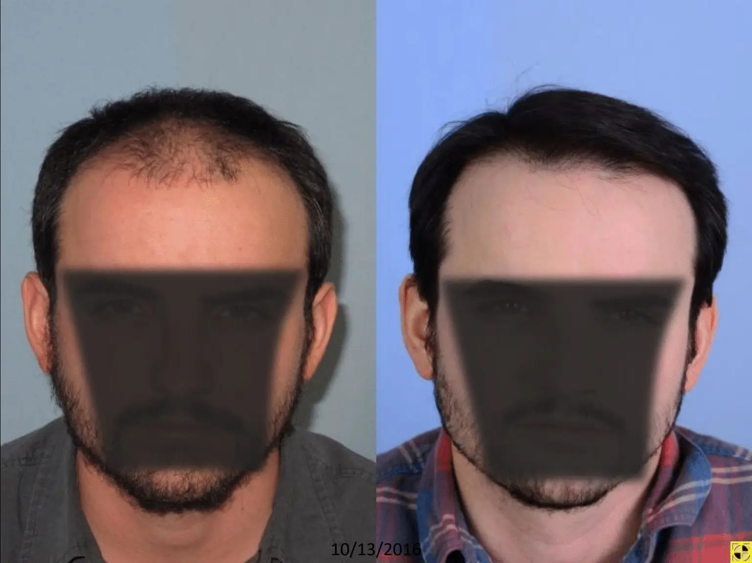 Before and after images of a male patient showing hair restoration results. The left side depicts thinning hair and a receding hairline, while the right side illustrates a fuller head of hair with improved density and coverage. The background is light blue, enhancing the visibility of the hair transformation. This image highlights the effectiveness of hair restoration procedures for individuals experiencing hair loss.