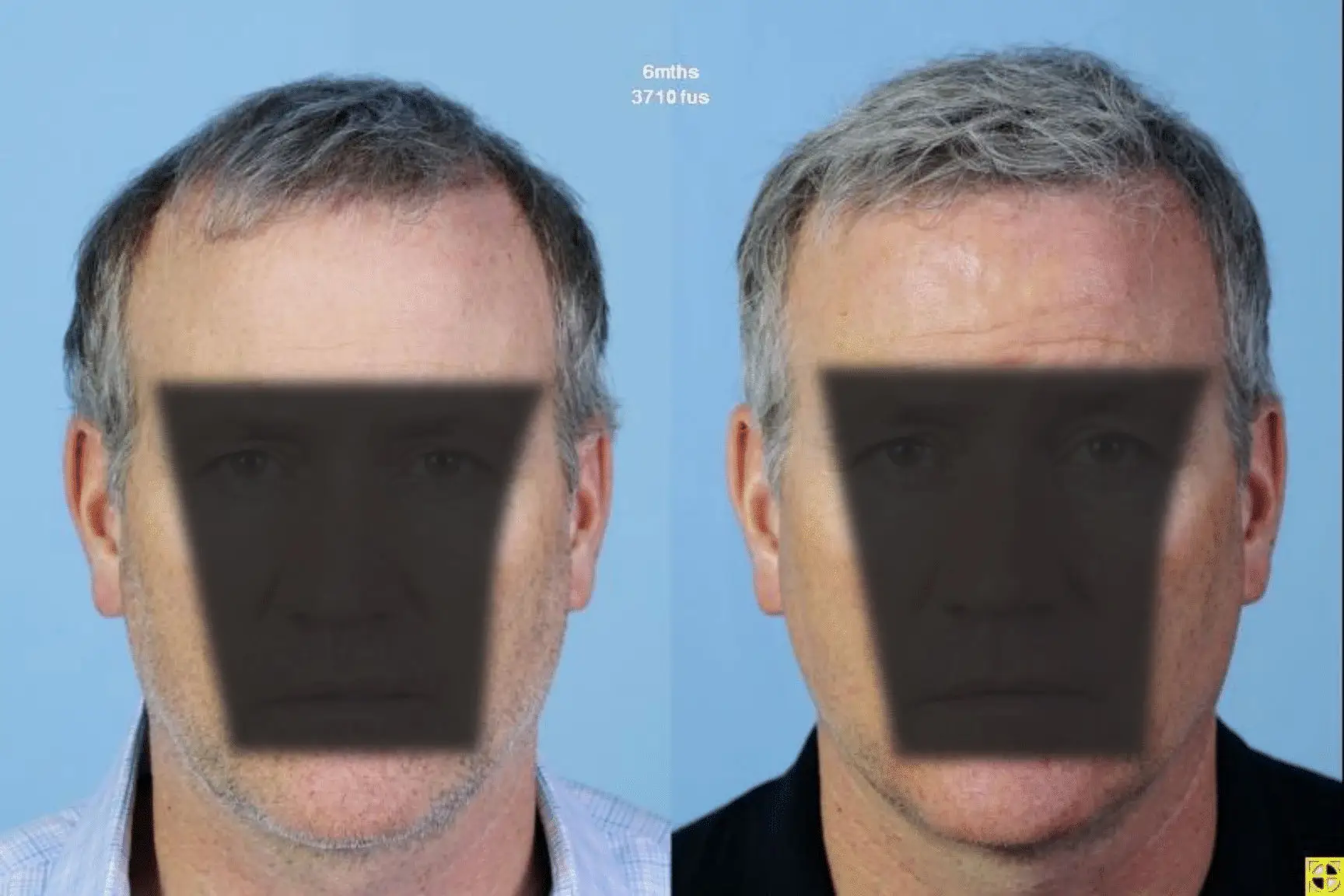 Image showing two side-by-side portraits of a man with medium-length gray hair against a light blue background. The left portrait features the man wearing a white shirt, while the right portrait shows him in a black shirt. Both images have a blurred overlay obscuring the facial features, emphasizing a focus on the clothing and hair rather than the identity of the individual. This image may be used to discuss topics related to identity, fashion choices, or visual perception.