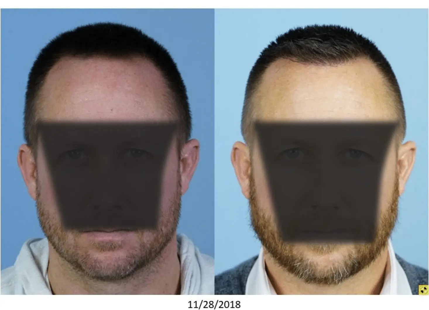 Before and after images of a male subject showing the effects of a cosmetic procedure. The left side displays the subject with a clean-shaven face, while the right side shows the same individual with a well-groomed beard and a fuller hairstyle. Both images are set against a light blue background, providing a clear view of the transformation. The date at the bottom indicates the images were taken on November 28, 2018. This visual comparison highlights the changes in facial appearance due to grooming and styling