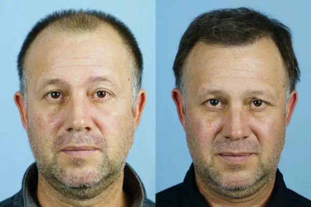 Before and after transformation of a middle-aged man, showcasing hair restoration results. The left side displays thinning hair, while the right side shows a fuller hairstyle. Both images feature the man against a light blue background, emphasizing the difference in hair volume and appearance. The man has a neutral expression in both photos, allowing for a clear comparison of the hair restoration process. This image highlights the effectiveness of hair restoration treatments for individuals experiencing hair loss.