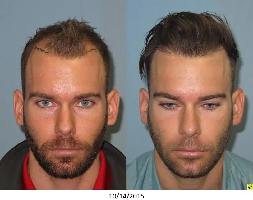 Image shows two side-by-side photographs of a man taken on different dates. The left photo captures him with shorter hair and a beard, while the right photo displays him with longer hair and a clean-shaven face. Both images feature a neutral background and focus on the individual's facial features. The dates at the bottom indicate the photos were taken on 10/14/2015. This comparison highlights changes in hairstyle and grooming over time, which may be relevant for discussions on personal transformation or identity.