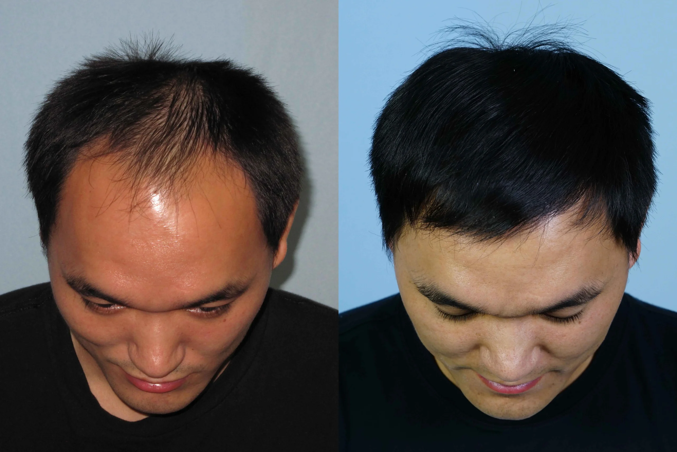 Before and after image showing hair restoration results on a man. The left side depicts thinning hair with visible scalp, while the right side shows a fuller head of hair. Both images capture the man looking down, highlighting the contrast in hair density and overall appearance. This visual representation illustrates the effectiveness of hair restoration treatments for individuals experiencing hair loss.