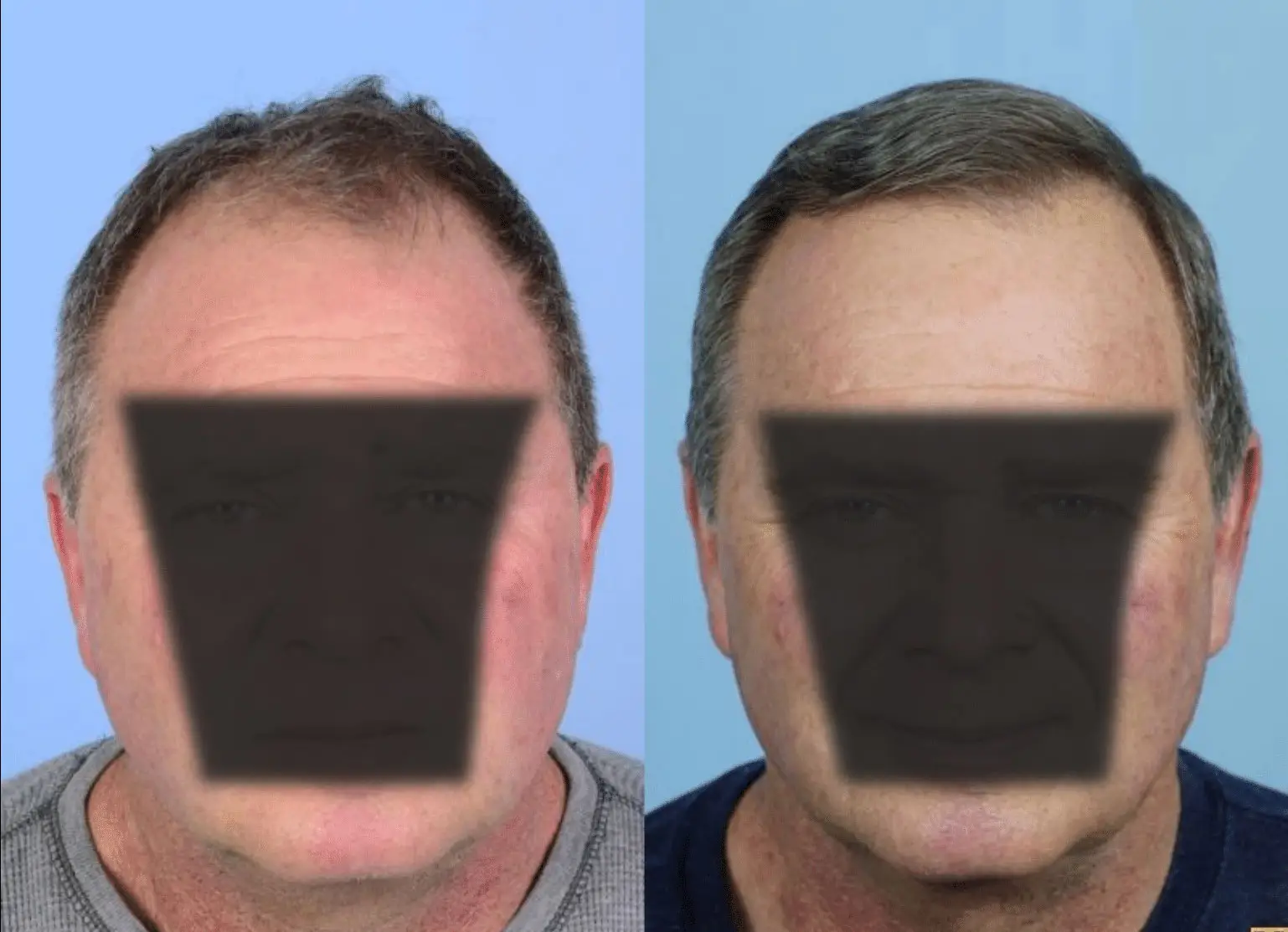 Before and after images showcasing a male patient who underwent a hair restoration procedure. The left side displays thinning hair and a receding hairline, while the right side shows a fuller head of hair with improved hairline aesthetics. Both images highlight the effectiveness of the treatment in enhancing the patient’s overall appearance and confidence. The background is a simple blue, emphasizing the subject’s transformation. This visual representation serves to inform potential patients about the results of hair restoration options.