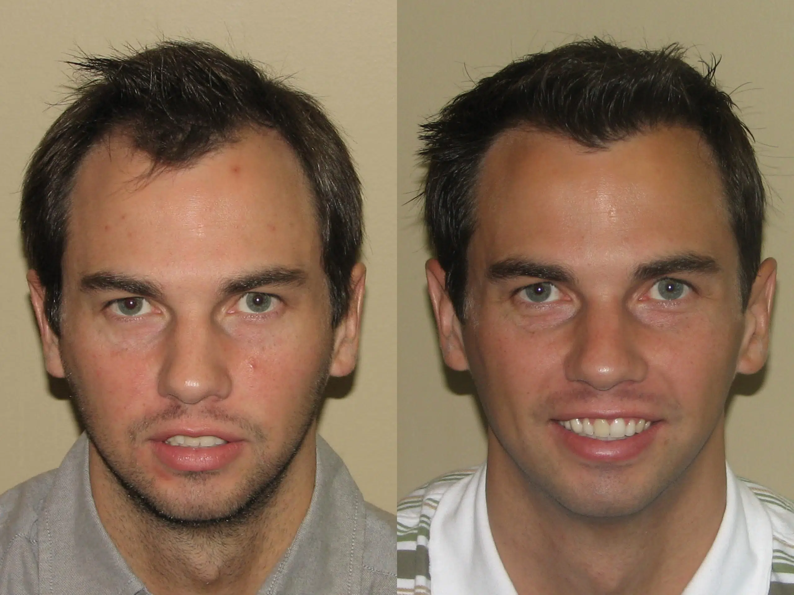 Before and after photos showcasing a male subject's transformation, highlighting changes in facial appearance and grooming. The left image displays a more unkempt look, featuring a serious expression and disheveled hair. In contrast, the right image shows the same individual with a polished appearance, smiling and well-groomed. This visual comparison emphasizes the impact of personal grooming and style changes on overall confidence and presentation. Ideal for discussions on self-improvement, grooming tips, or personal transformation stories.