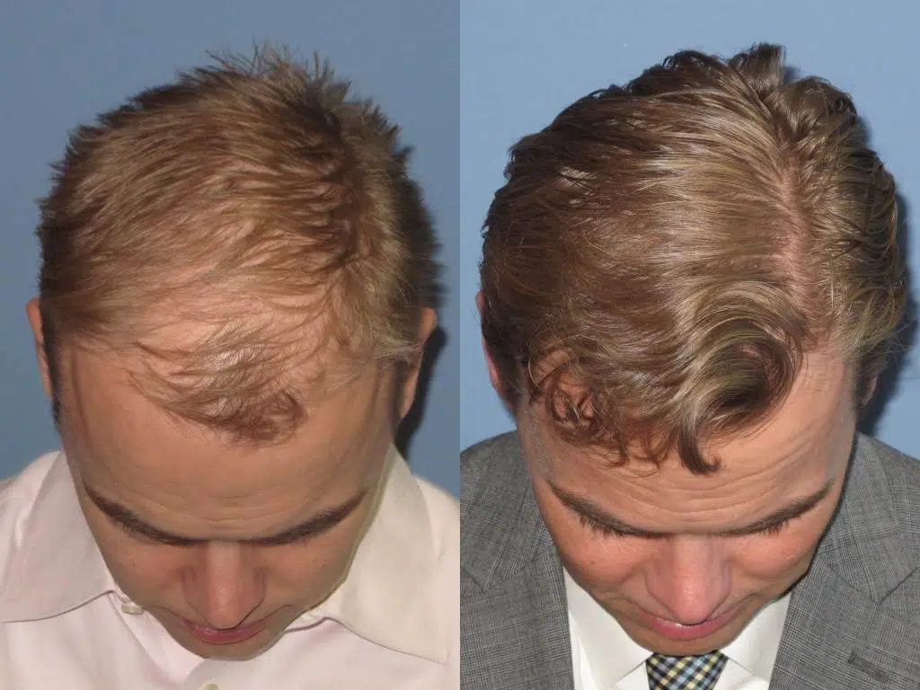 Before and after images of a male patient showing the results of a hair restoration procedure. The left side displays thinning hair and a receding hairline, while the right side shows fuller, thicker hair with improved styling. The images highlight the effectiveness of the treatment in restoring hair density and overall appearance. Suitable for discussions on hair loss solutions, hair restoration techniques, and patient outcomes in cosmetic procedures.