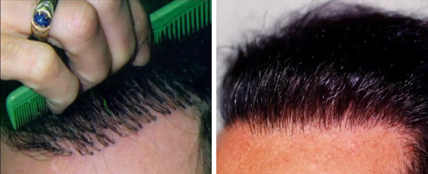Before and after hair restoration treatment showcasing the transformation of hair thickness and style. On the left, a close-up of a person's scalp with visible hairline and combing action. On the right, the same individual's enhanced hairstyle with fuller, healthier-looking hair. This image illustrates the effectiveness of hair restoration techniques, highlighting the improvement in appearance and confidence. Ideal for individuals considering similar treatments, it emphasizes the potential results of hair restoration solutions.
