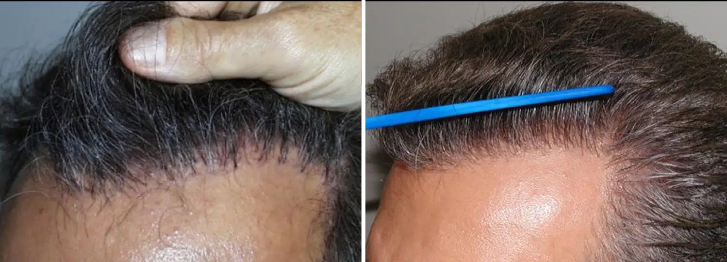 Before and after images of a hair restoration procedure, showing the scalp on the left with visible hair follicles post-treatment and the right side displaying fuller, styled hair. The images highlight the transformation achieved through the procedure, emphasizing improved hair density and a natural-looking hairline. Ideal for individuals considering hair restoration options, this visual comparison illustrates the effectiveness of modern hair transplant techniques.
