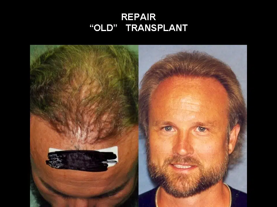 Before and after images showcasing a hair transplant repair. The left side displays a man's receding hairline with visible signs of an old hair transplant, while the right side shows the same man with a fuller, natural-looking hairstyle after the repair procedure. The text above emphasizes the transformation achieved through modern hair restoration techniques. This image highlights the effectiveness of hair transplant repair for individuals seeking to improve their appearance and regain confidence.