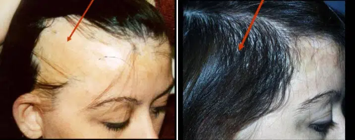 Image showing two close-up views of a woman's scalp. The left image highlights hair thinning and receding hairline, while the right image features a section of hair with a visible hair accessory. Both images illustrate common hair concerns, emphasizing the importance of hair health and styling options. This visual is relevant for discussions on hair restoration treatments and styling techniques for thinning hair.