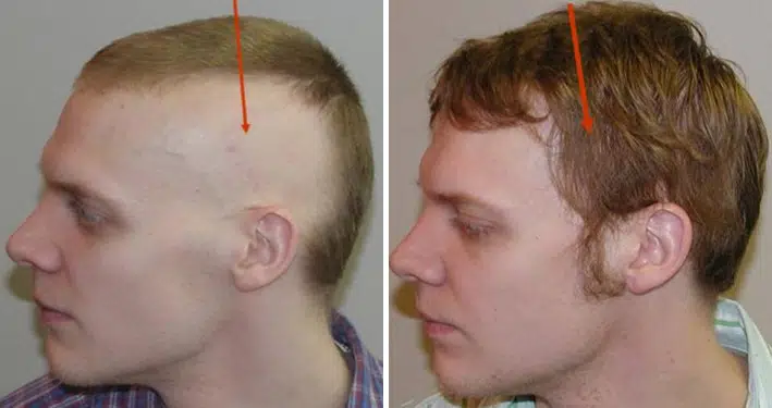Profile view comparison of two individuals illustrating different hairstyles. The left image shows a man with a shaved head and a prominent mohawk, while the right image features a man with medium-length, tousled hair. Both images are marked with arrows indicating specific points of interest on their heads. The background is neutral, ensuring the focus remains on the hairstyles. This visual serves to highlight the diversity in haircuts and styles, useful for discussions on personal expression and hair trends.