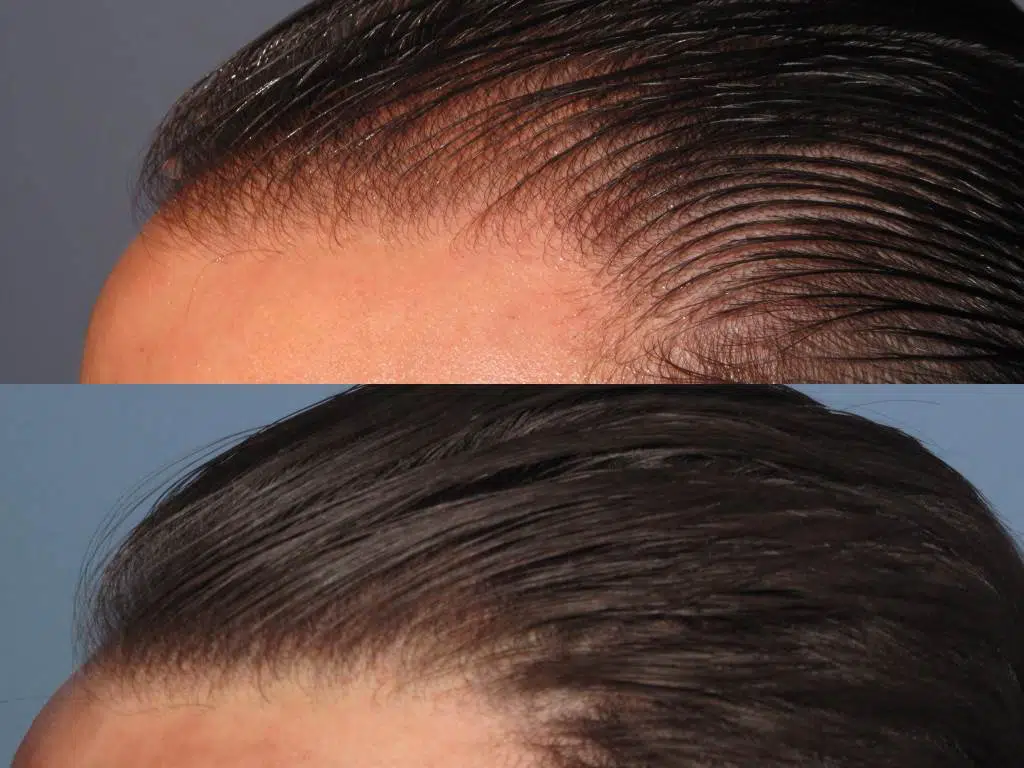 Before and after images of a hair restoration treatment showing a significant improvement in hair density and coverage. The top image displays thinning hair at the hairline, while the bottom image showcases fuller, healthier-looking hair. This visual comparison highlights the effectiveness of the treatment for individuals experiencing hair loss, emphasizing the potential for natural-looking results. Ideal for those researching hair restoration options, this image serves as a valuable resource for understanding the benefits of hair restoration procedures.