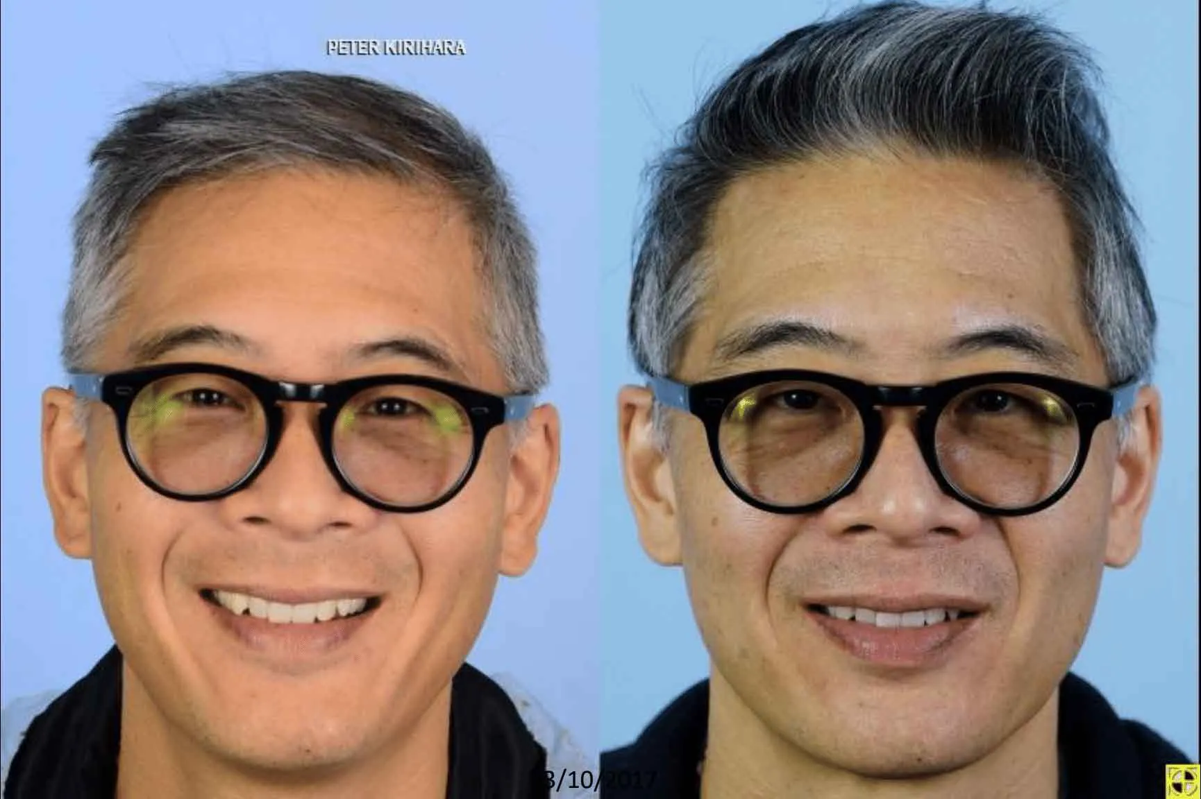 A side-by-side comparison of a middle-aged man with gray hair wearing black glasses, smiling confidently. The left side shows him with a more relaxed expression, while the right side features a slightly more polished look. The background is a light blue, enhancing the focus on the subject's facial features. This image highlights the man's approachable demeanor and showcases the impact of different expressions on personal presentation. Ideal for discussions on personal branding, confidence, or the influence of visual appearance in social interactions.