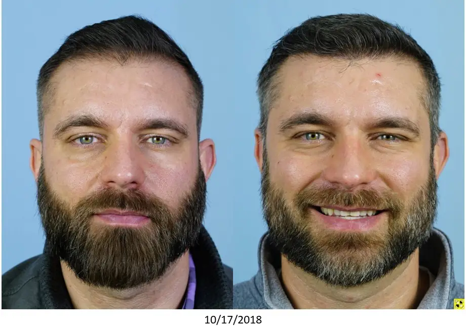 Before and after image showing a man with a beard. The left side depicts the individual with a neutral expression, looking serious, while the right side shows him smiling, highlighting a noticeable transformation. The background is a light blue color, and the date at the bottom indicates the image was taken on December 17, 2018. This image may illustrate a personal change or grooming improvement, showcasing the impact of a new hairstyle or beard grooming technique. Ideal for discussions on personal style, grooming tips, or