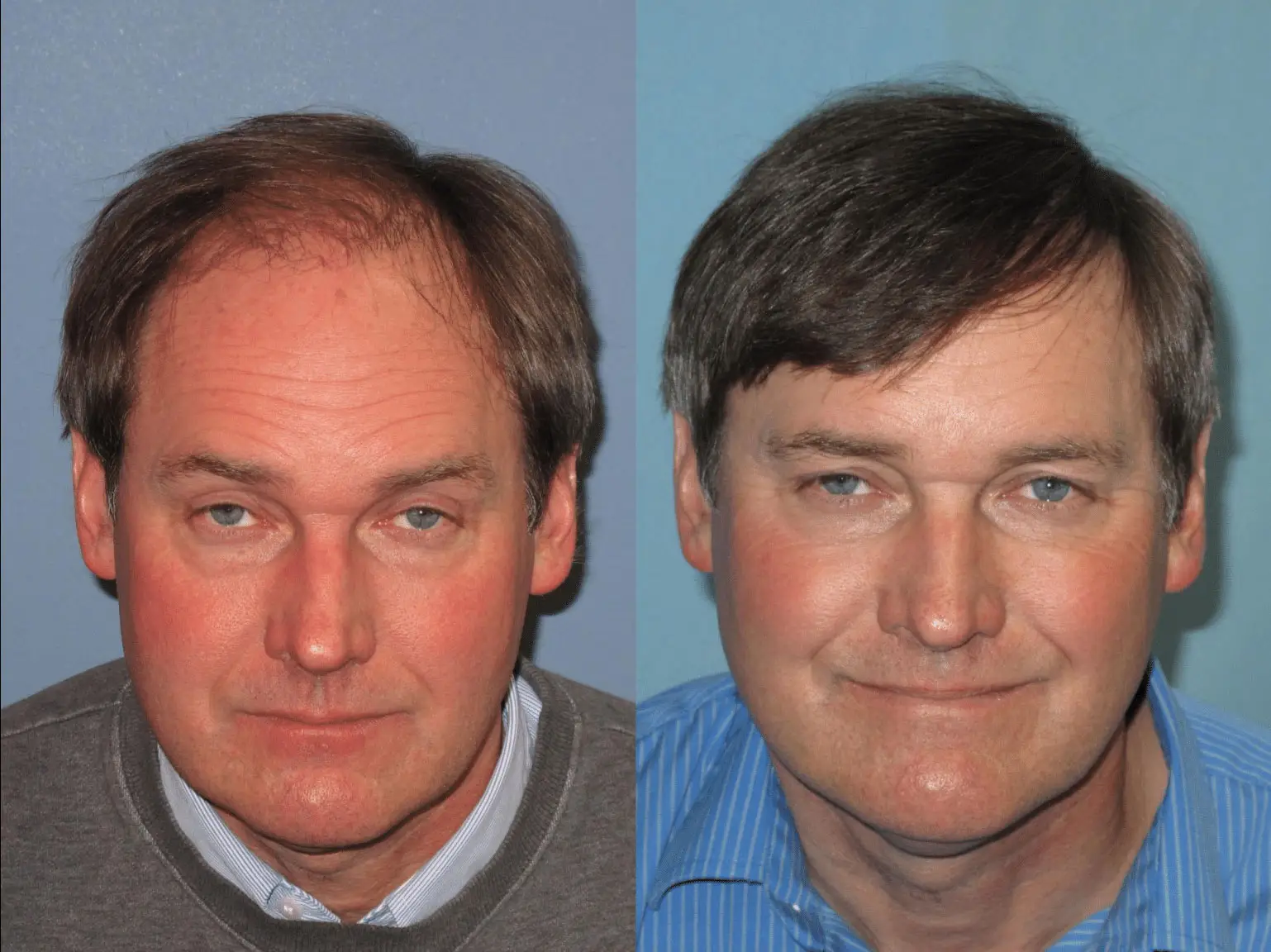 Before and after photos of a middle-aged man showcasing the effects of a hair restoration treatment. The left image displays noticeable hair thinning and a receding hairline, while the right image presents a fuller head of hair and a more youthful appearance. Both images have a neutral background, emphasizing the subject's transformation. This visual comparison highlights the benefits of hair restoration solutions for individuals experiencing hair loss.
