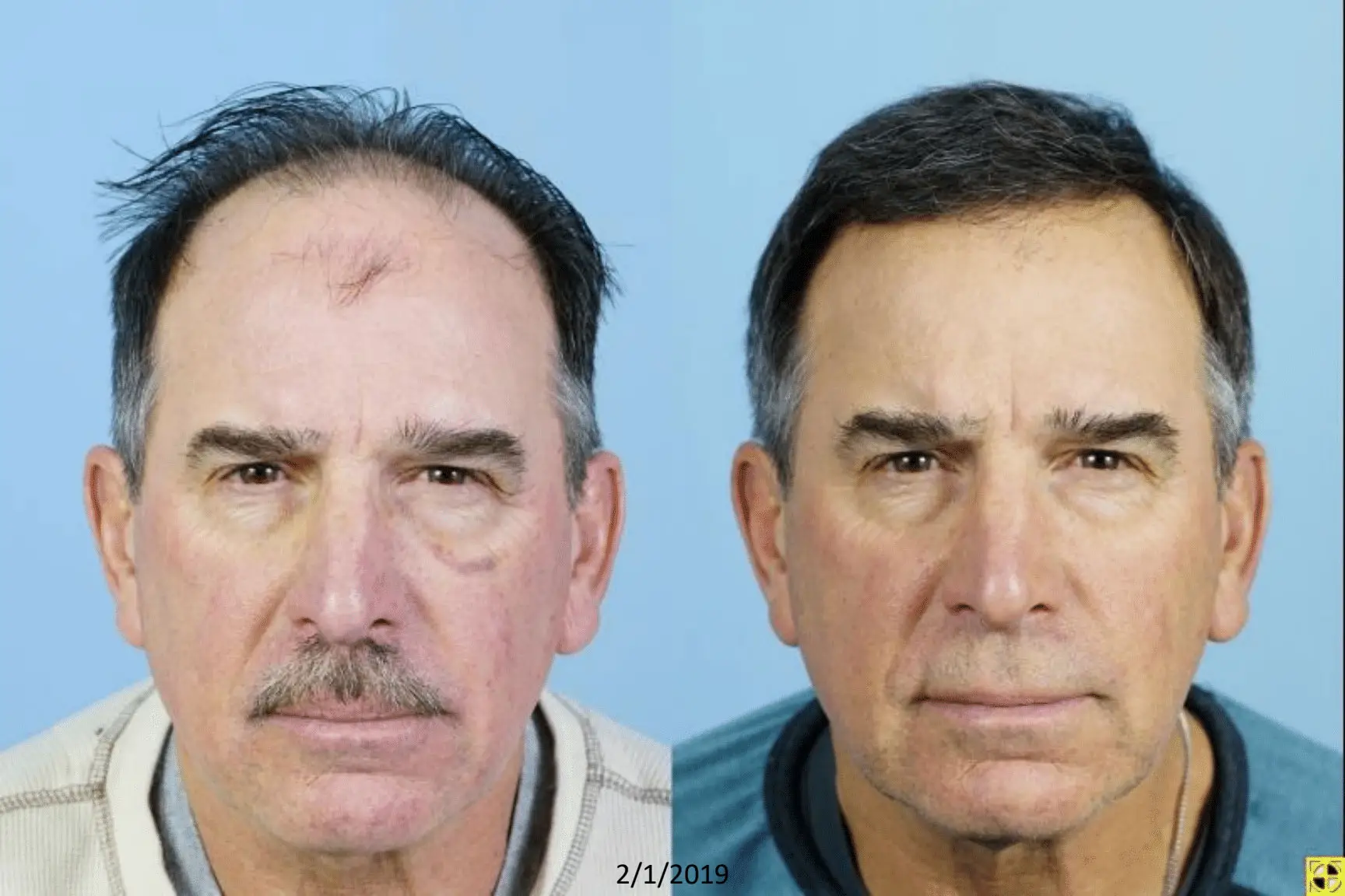 Before and after photo of a middle-aged man showcasing the effects of a cosmetic procedure. The left side displays visible signs of aging, including wrinkles and thinning hair, while the right side presents a smoother complexion and fuller hair. Both images are set against a light blue background, highlighting the transformation. This visual comparison emphasizes the benefits of cosmetic treatments in enhancing facial appearance and confidence.