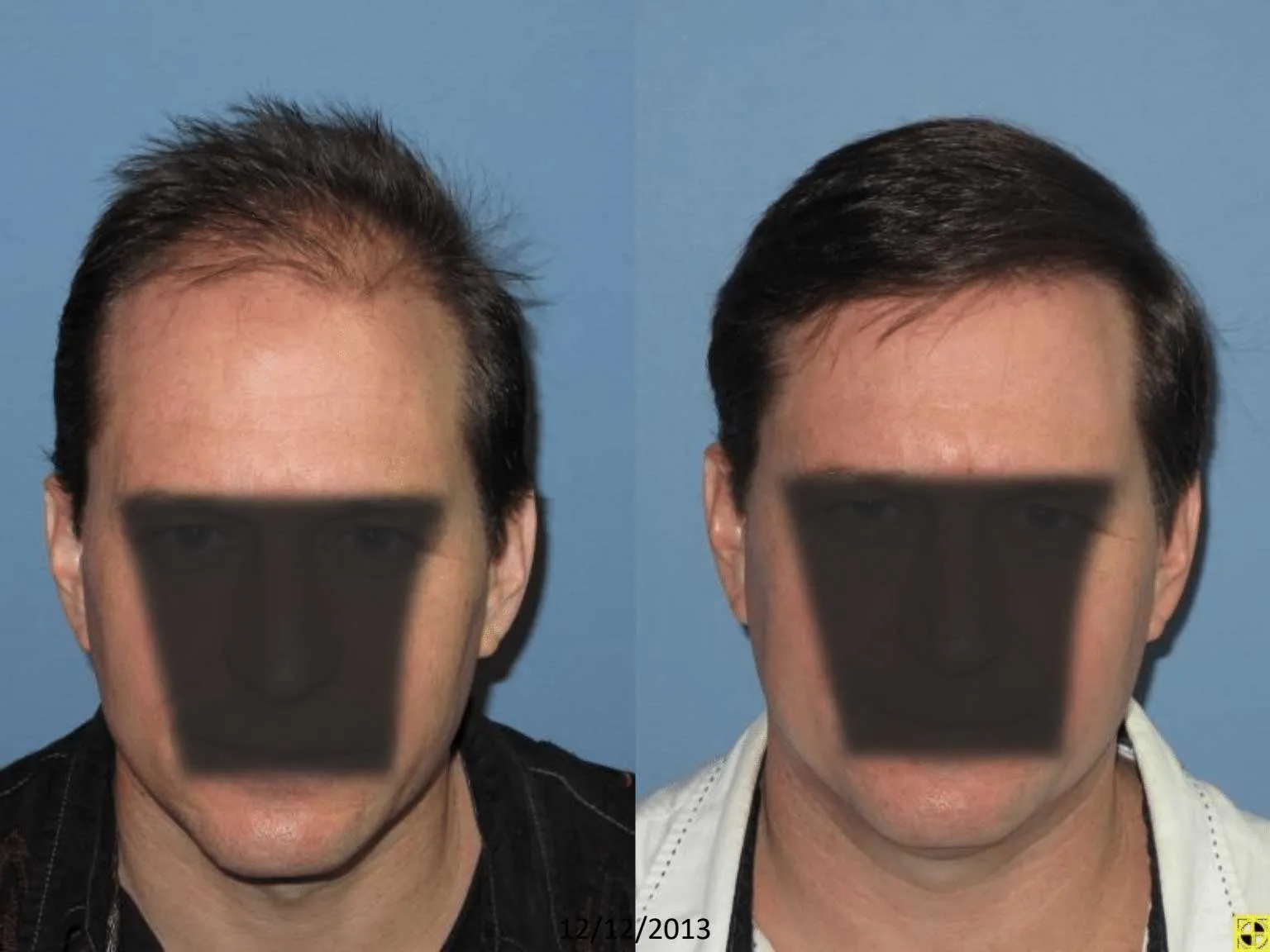 Before and after images of a male patient showcasing hair restoration results. The left side displays thinning hair and a receding hairline, while the right side illustrates a fuller head of hair with improved volume and coverage. The transformation highlights the effectiveness of hair restoration treatments, emphasizing the potential for enhanced appearance and self-confidence. The background is a solid blue, ensuring focus on the hair restoration results. This image serves as a visual representation of the benefits of hair restoration procedures.