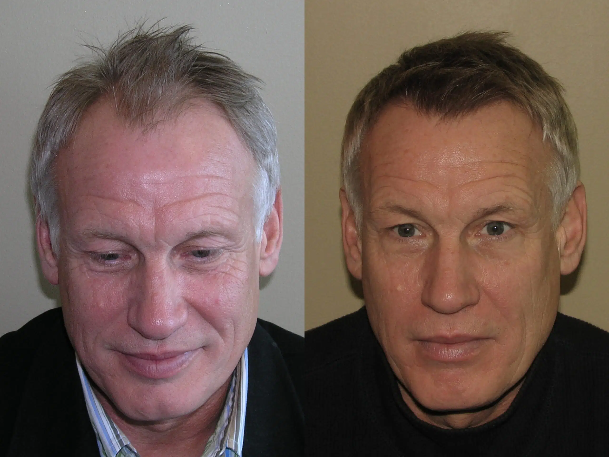 Before and after photos of a middle-aged man showing the effects of a cosmetic procedure. The left image depicts him with a slightly tired expression and disheveled hair, while the right image presents a more youthful appearance with a smoother complexion and styled hair. The background is neutral, focusing on the subject's face. This comparison highlights the transformative results of the procedure, emphasizing improved facial aesthetics and confidence.