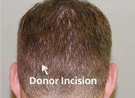 DONOR STRIP REMOVED Follow angle of hair