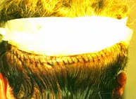 DONOR SUTURED Trichophytic
