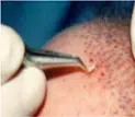 Grafts Placement