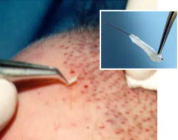 Grafts are Placed Gently