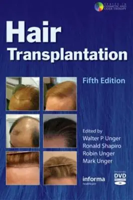 Hair-Transplantation-1