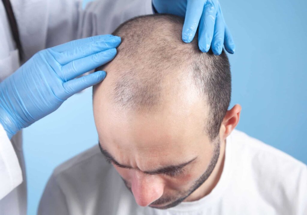A healthcare professional wearing blue gloves examines a man's thinning hair and scalp. The man is seated and appears to be concerned about hair loss. This image highlights the importance of scalp assessments in hair restoration treatments, emphasizing the role of medical expertise in addressing hair loss issues. Suitable for articles on hair loss solutions, scalp health, and dermatological consultations.