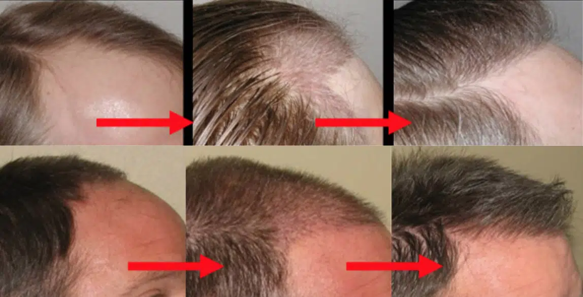 Before and after images of hair restoration treatments showing varying degrees of hair loss and regrowth. The top row displays initial stages of hair thinning and receding hairlines, while the bottom row highlights successful hair restoration results. Each image is marked with arrows indicating specific areas of improvement, demonstrating the effectiveness of the treatment. This visual comparison is useful for individuals considering hair restoration options, providing insight into potential outcomes.