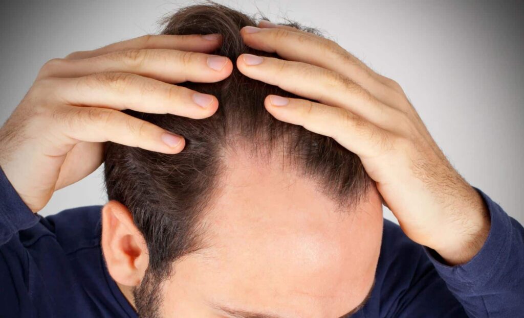A man examining his thinning hairline with both hands, showing signs of hair loss. The image highlights the concern of male pattern baldness, often affecting men in their 20s and 30s. The background is neutral, focusing on the individual’s hair condition. This visual representation can be relevant for discussions on hair restoration treatments, hair care products, and the emotional impact of hair loss.