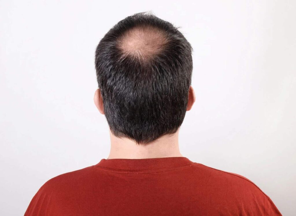 Image of the back of a man’s head showing a receding hairline and thinning hair. The individual is wearing a red shirt and has short, dark hair with noticeable balding at the crown. The background is plain white, emphasizing the subject's hairstyle. This image can be used in discussions about hair loss, male pattern baldness, or hair restoration options. It visually represents common concerns related to hair thinning and is relevant for articles or resources focused on men's health and grooming.