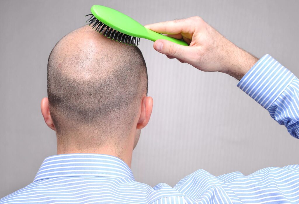 A man with a bald head is brushing his scalp with a green hairbrush. He is wearing a light blue striped shirt and is facing away from the camera. The image illustrates hair care practices and grooming routines for individuals with hair loss.