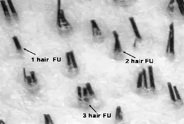 Microscopic image showing hair follicle units (FUs) with varying counts: labeled "1 hair FU," "2 hair FU," and "3 hair FU." The image highlights the distinct structures of each follicle unit, which are crucial for hair transplantation and restoration procedures. The clarity of the image allows for detailed examination of the hair follicles, aiding in the understanding of their density and arrangement. This visual resource is beneficial for medical professionals and patients interested in hair restoration techniques.