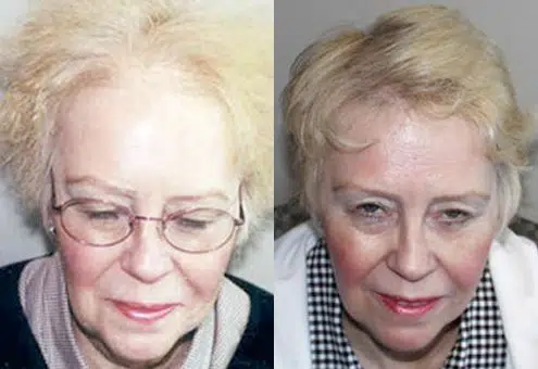 Before and after images of an elderly woman showcasing the effects of a cosmetic procedure. The left side displays her with lighter, unstyled hair and minimal makeup, while the right side shows her with styled hair and enhanced makeup, highlighting a more youthful appearance. The images emphasize the transformation achieved through the procedure, illustrating changes in facial features and overall look. These visuals can be used to inform potential clients about the results of cosmetic treatments aimed at rejuvenating appearance in older adults.
