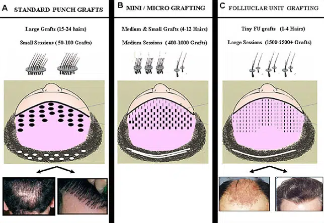 Illustration comparing three methods of hair transplantation: A) Punch grafts, showing round sections of hair follicles; B) Mini/micro grafts, illustrating smaller hair follicle groups; C) Follicular unit grafts, depicting individual hair follicle clusters. Each method is represented with diagrams highlighting the density and arrangement of grafts on the scalp. This educational image serves to inform viewers about different hair restoration techniques and their application in cosmetic procedures, promoting understanding of options available for hair loss treatment.