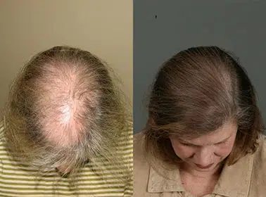 Before and after images showcasing hair restoration results. The left side displays a person with significant hair loss, highlighting a receding hairline and thinning hair. The right side features the same individual after treatment, showing improved hair density and a fuller appearance. This visual contrast illustrates the effectiveness of hair restoration techniques, emphasizing the potential for regrowth and enhanced confidence. Ideal for those exploring solutions for hair loss.