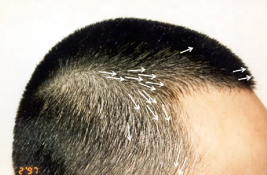 Close-up view of a scalp with hair follicles marked by small white arrows, indicating the direction of hair growth. The image highlights the texture of short hair and the transition between different hair lengths. This visual can be useful for discussions on hair restoration techniques, scalp health, or hair growth patterns.