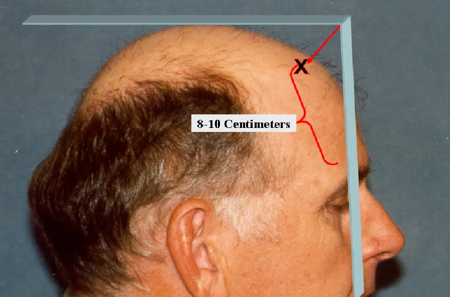 Profile view of a man showing hair loss, with a focus on the receding hairline. The image includes measurements indicating a distance of 8-10 centimeters from the hairline to the marked point. This visual representation is useful for illustrating patterns of male pattern baldness and can assist in discussions about hair restoration options. The clear labeling and measurement provide valuable context for understanding hair loss progression.
