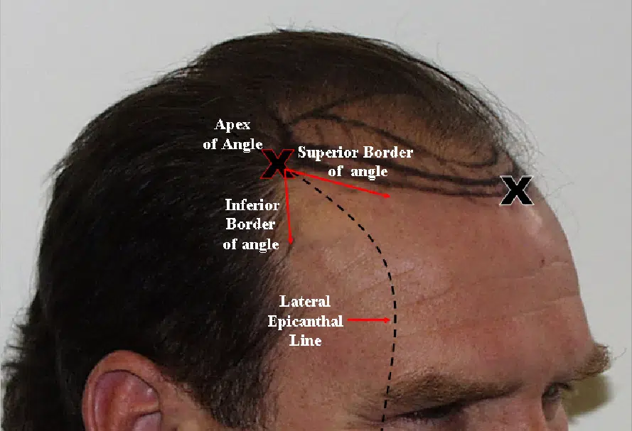 Diagram illustrating the anatomical landmarks of the forehead and hairline. The image labels key areas, including the Superior Border of Angle, Inferior Border of Angle, and Lateral Ephemeral Line. This visual aids in understanding the angles and borders relevant in hair restoration or cosmetic procedures. The focus is on precise anatomical references that are important for medical professionals and patients considering hairline adjustments.
