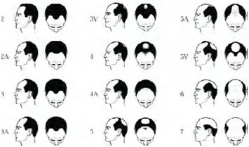 Illustration depicting various male head shapes and hairstyles, arranged in a grid format. The image showcases seven different styles, labeled with numbers and letters, highlighting variations in hairline and crown shapes. This visual guide is useful for understanding different male hair types and styles, aiding in hairdressing, styling, and personal grooming decisions. The monochrome design allows for clear visibility of each hairstyle without color distractions. Ideal for barbers, hairstylists, and individuals seeking to explore diverse hair options.