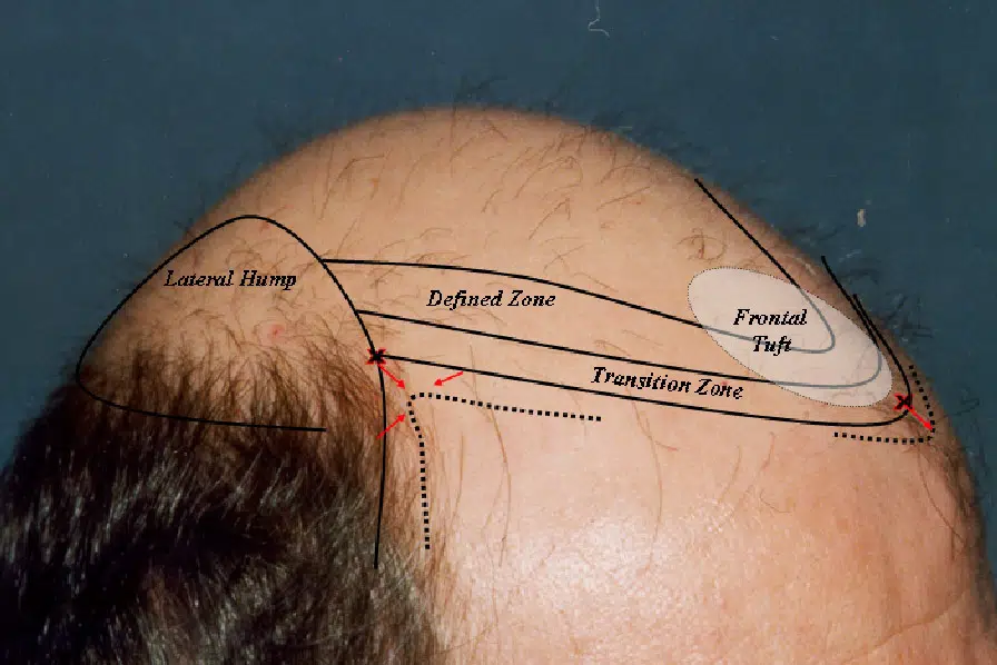 Image of a bald head with labeled areas indicating different zones of hair loss. The labels include "Connect Zone," "Defined Zone," "Frontal Zone," and "Transition Zone." The illustration highlights the pattern of hair thinning and suggests areas for potential hair restoration or treatment. This educational image serves as a reference for understanding male pattern baldness and its progression.