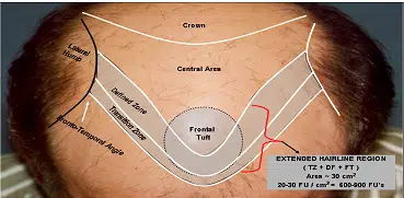 Diagram illustrating the structure of a hair follicle, highlighting key areas such as the crown, central zone, and frontal tuft. The image also indicates the dermal zone and the terminal drill, providing a clear overview of hair follicle anatomy. Labels are included to identify each section, with a scale showing dimensions of 20-30 microns. This educational graphic serves as a resource for understanding hair biology and can assist in studies related to dermatology and trichology.