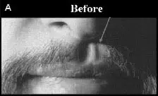 Close-up image of a man's face showing the area around the nose and upper lip, highlighting facial hair. The image is labeled "Before," indicating a transformation or treatment process. The focus is on the texture and appearance of the mustache and surrounding skin, providing a clear view for comparison in a before-and-after scenario. This visual representation can be used in discussions about grooming, skincare, or cosmetic procedures.