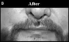 Close-up image of a man's face showcasing the area around the nose and mouth after a grooming or styling process. The image highlights a well-defined mustache and beard, emphasizing a clean and polished appearance. The word "After" is displayed above, indicating this is a post-grooming transformation. The black and white format adds a dramatic effect, focusing on the details of facial hair. This image serves as a visual reference for grooming results, appealing to those interested in beard and mustache care.