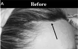 Before image showing a close-up view of hairline with an arrow indicating the area of concern. The image highlights thinning hair or receding hairline, emphasizing the need for hair restoration solutions. The text "Before" is prominently displayed at the top, indicating this is a preliminary assessment for potential treatment options. This visual serves to illustrate the starting point in a hair restoration journey, making it relevant for individuals seeking solutions for hair loss.