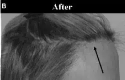 Image showing the "After" results of a hair restoration treatment, highlighting improved hair density and coverage. The close-up view focuses on the hairline, indicating significant restoration with a visible arrow pointing to a specific area of enhancement. This visual demonstrates the effectiveness of the treatment in addressing hair thinning or loss, appealing to individuals seeking solutions for hair restoration. Ideal for use in promotional materials or informational content related to hair health and restoration services.