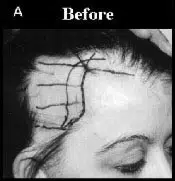 Before image showing a woman's scalp with visible markings indicating the areas for hair transplant preparation. The photo highlights the intricate grid pattern drawn on the forehead, which is a common step in hair restoration procedures. The woman's face is partially visible, indicating the context of the procedure. This image is part of a series documenting the stages of hair transplant surgery, focusing on the initial setup before the procedure begins.