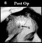 Post-operative image showing the scalp of a patient with visible surgical markings. The focus is on the area of hair restoration, indicated by arrows. The image highlights the post-operative condition and hair growth patterns, providing insight into the recovery process after hair transplant surgery. It serves as an educational reference for understanding post-operative care and expected outcomes in hair restoration procedures.